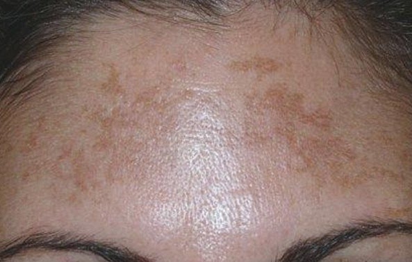 Image result for PIH skin